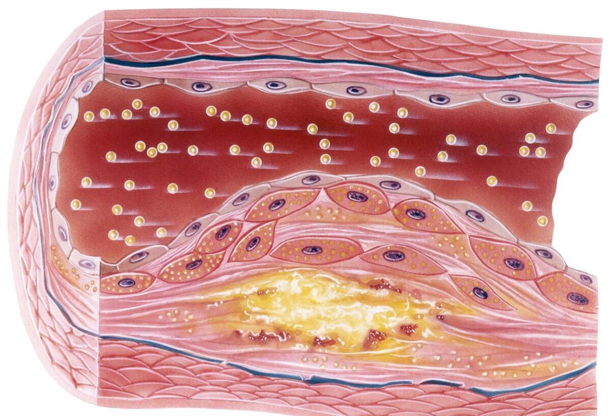 前沿醫(yī)療科技助力動脈斑塊治療新突破