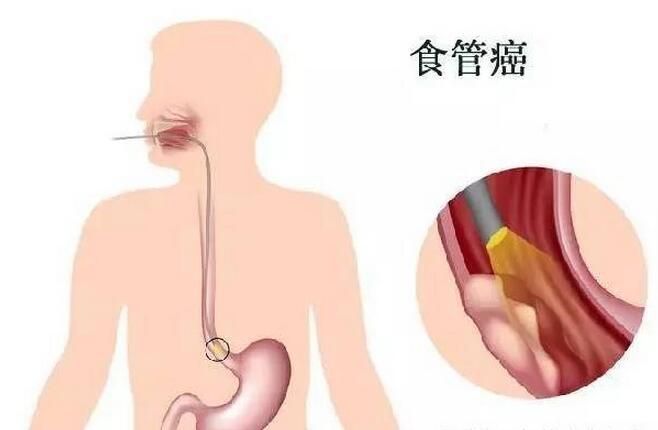 食道癌最新治療方法的研究進展與臨床應用