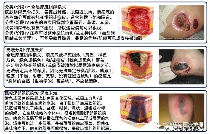 壓瘡最新分期與護(hù)理方法詳解